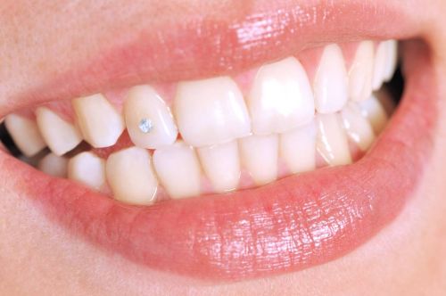 Tooth Gem und klassischer Zahnschmuck als dekorative Elemente für ein individuelles Lächeln