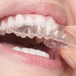 Aligner-Behandlung